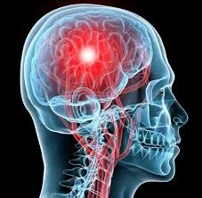 CONCUSSION