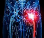 Piriformis Syndrome