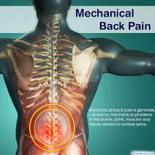 Mechanical back pain