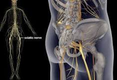Sciatica