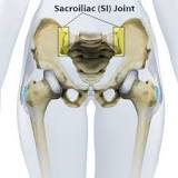 Sacroiliac joint dysfunction