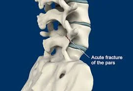 Stress fracture 