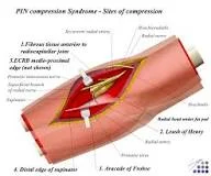 Radial Tunnel Syndrome