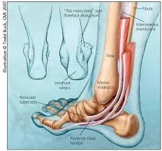 Posterior tibial tendon