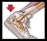 Achilles tendon rupture 