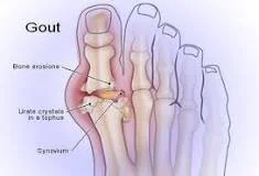 Gout