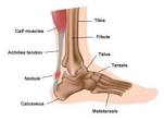 Achilles Tendinitis