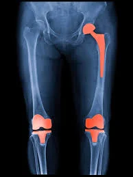 Total Knee Replacement Surgery