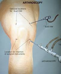 Knee Arthroscopy
