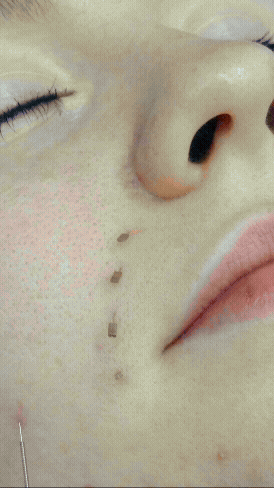 INTRADERMAL reel for gif.gif