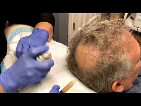 How We Do it: Platelet Rich Plasma Hair Loss Therapy