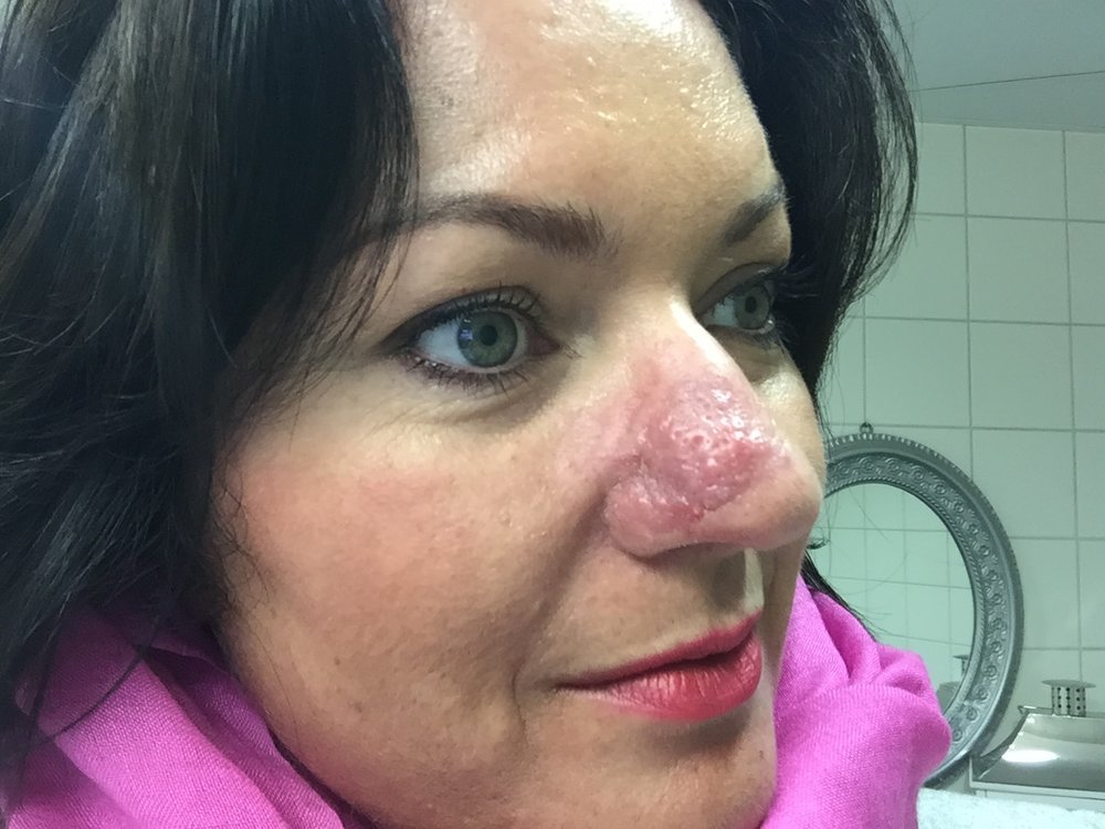 trine grung rosacea.jpeg