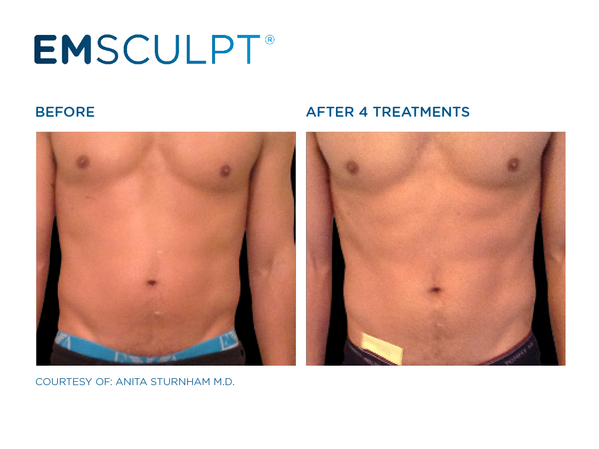 BTL-Emsculpt_PIC_Fb-social-media-plan-.png