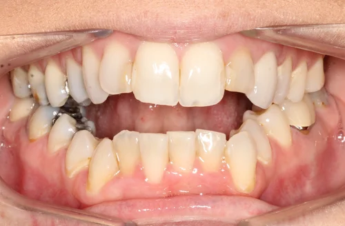 Before orthodontic treatment