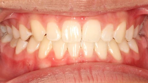 After orthodontic treatment