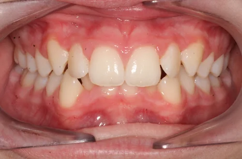 Before orthodontic treatment