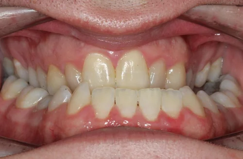 Before orthodontic treatment
