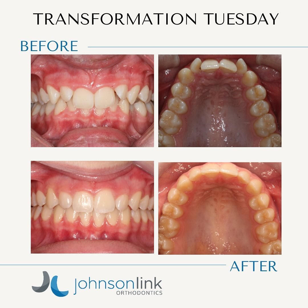 ✨TRANSFORMATION TUESDAY✨⁣
⁣
This patient came in with the concerns of a deep bite and crowding. This was all corrected with Invisalign.⁣
⁣
Call Johnsonlink Orthodontics to get that smile you&rsquo;ve always wanted!  #transformationtuesday #johnsonlin