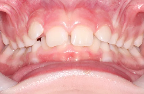 Before orthodontic treatment