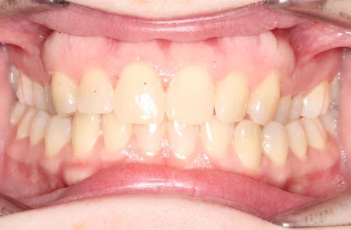 Before orthodontic treatment