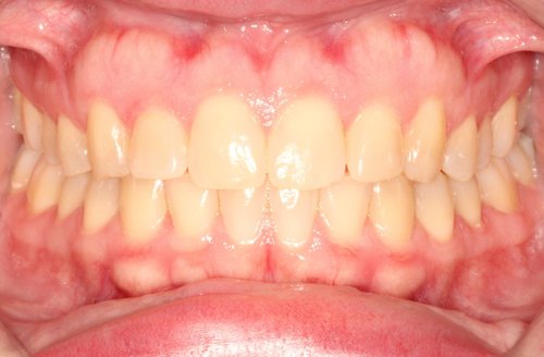 After orthodontic treatment