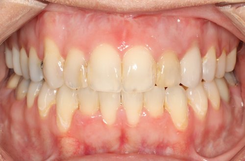 After orthodontic treatment