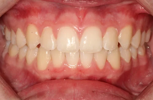 After orthodontic treatment