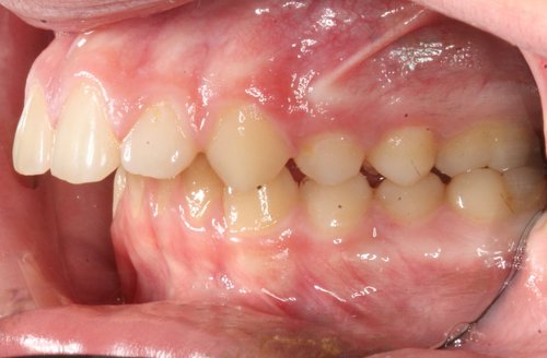 Before orthodontic treatment