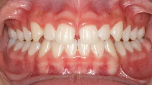 Before orthodontic treatment