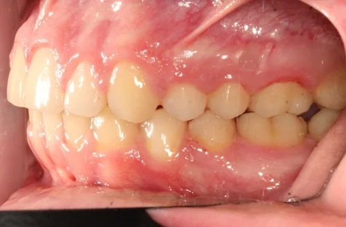 After orthodontic treatment