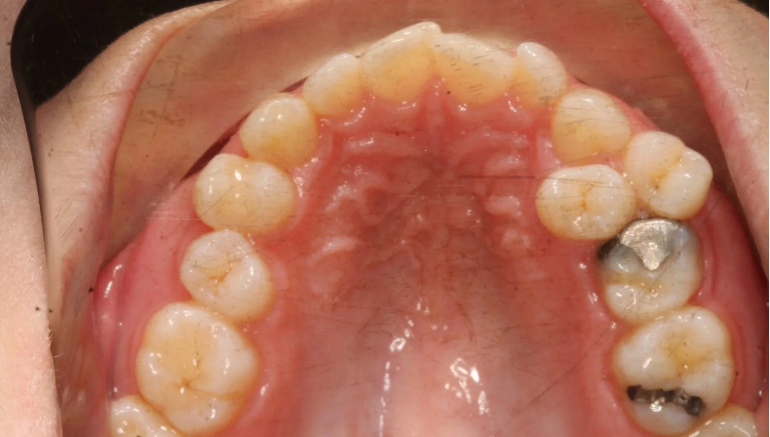Before orthodontic treatment