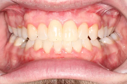 After orthodontic treatment