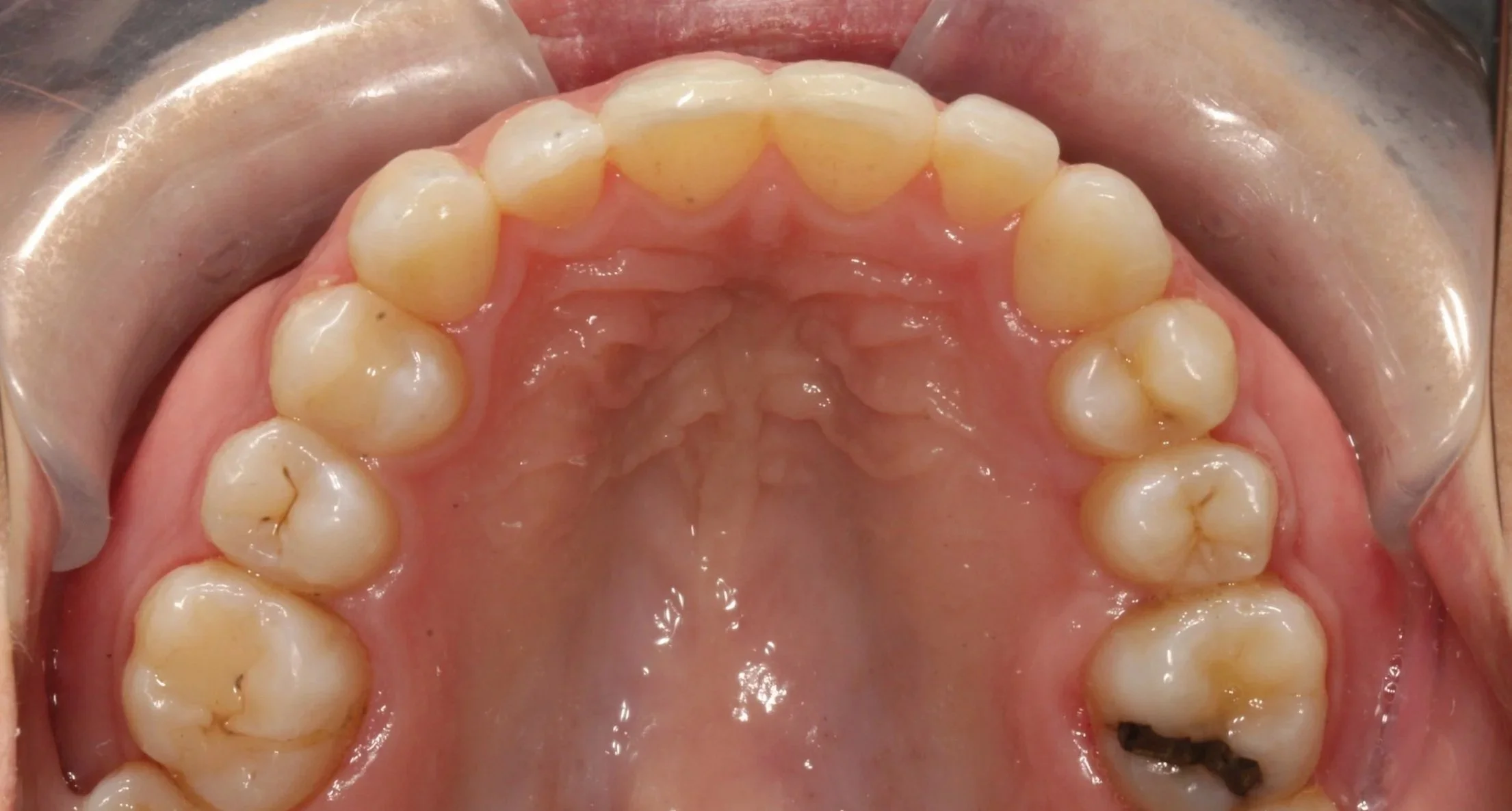 After orthodontic treatment
