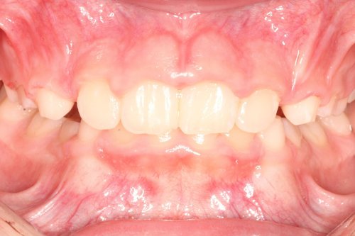 After orthodontic treatment