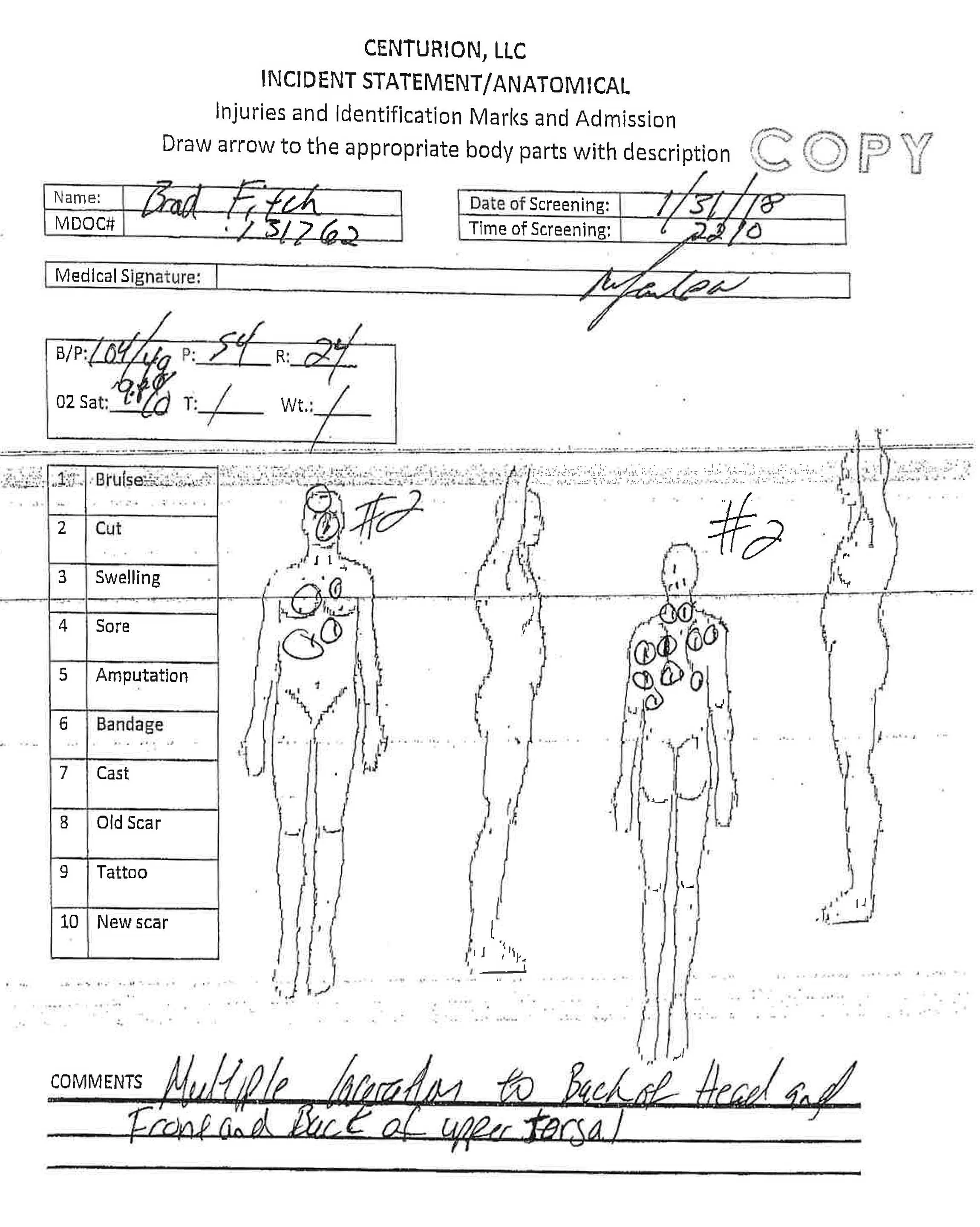 An anatomical diagram from the Mississippi Department of Correction's investigative report into Brad Fitch's death showed multiple lacerations to the back of the head and torso. Mississippi Department of Corrections