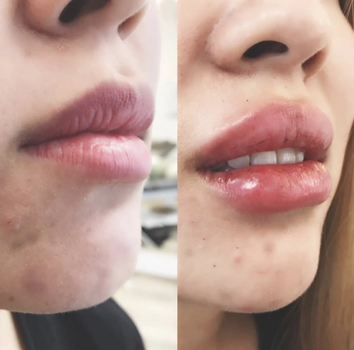 Juvederm Ultra 1ML