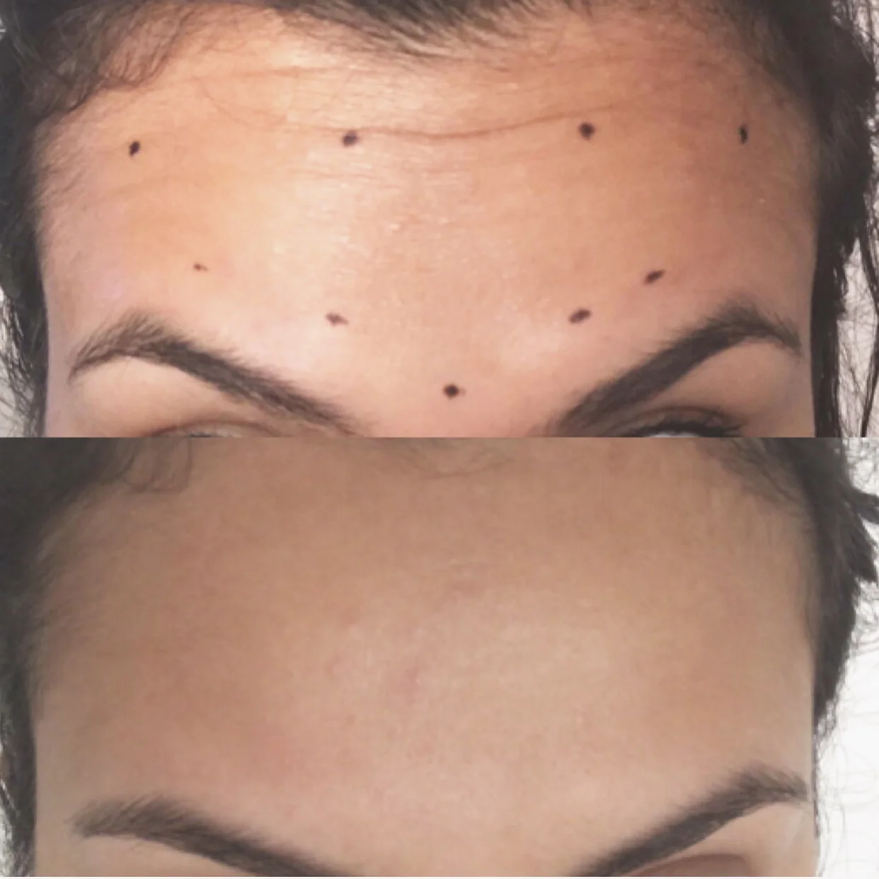 30 units of Botox