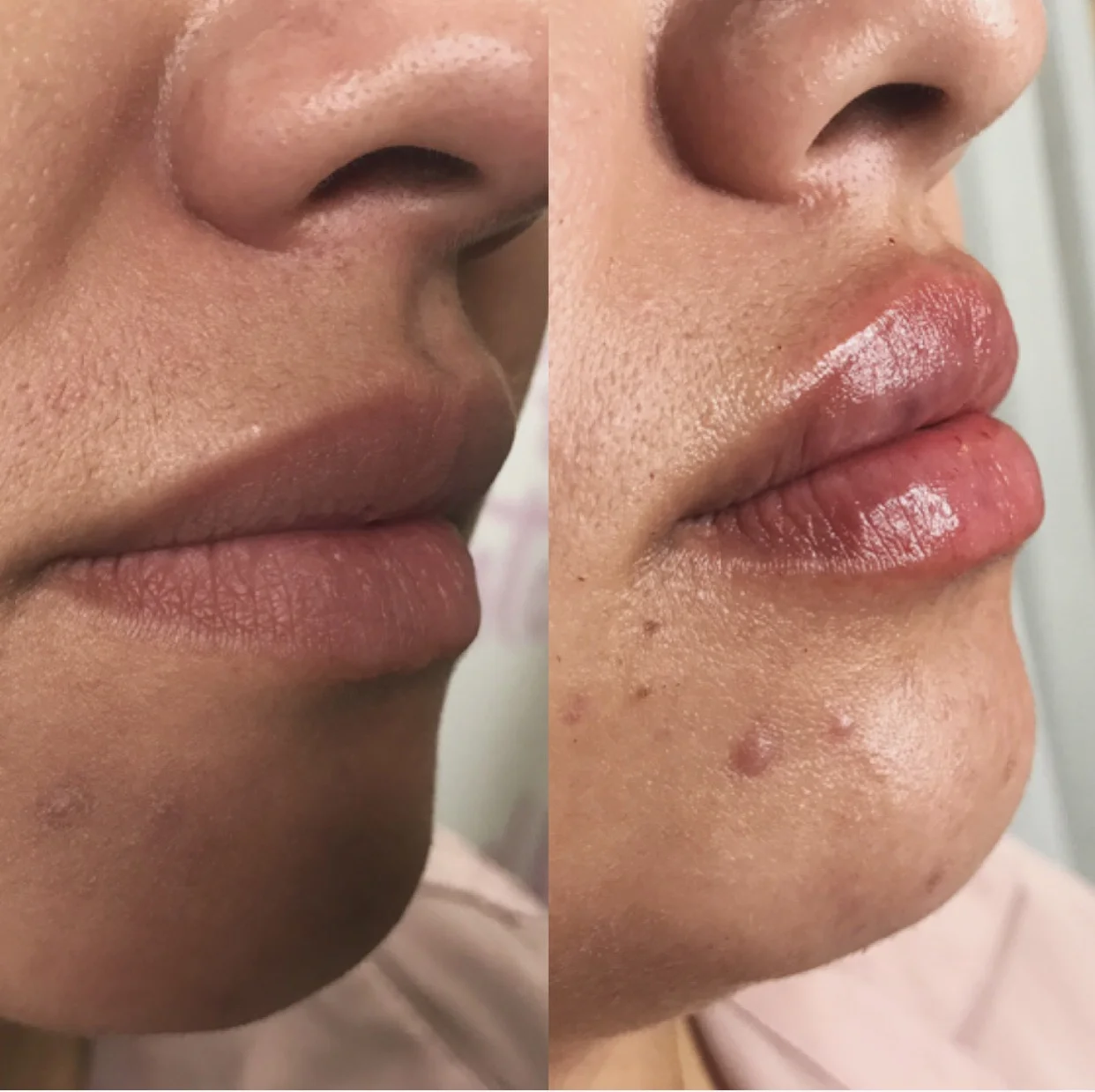 Juvederm UltrA