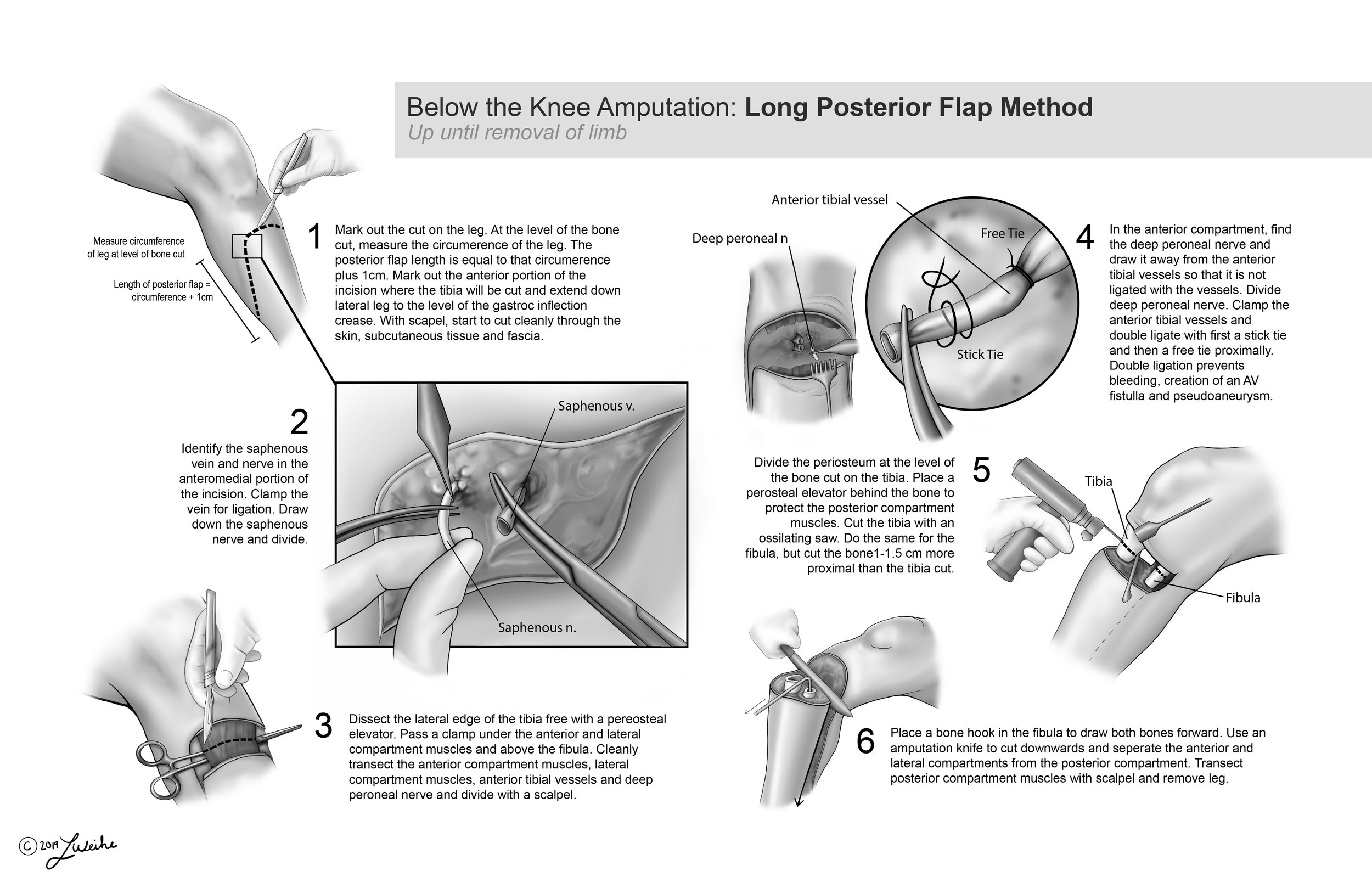Below the Knee Amputation: Long Posterior Flap Method
