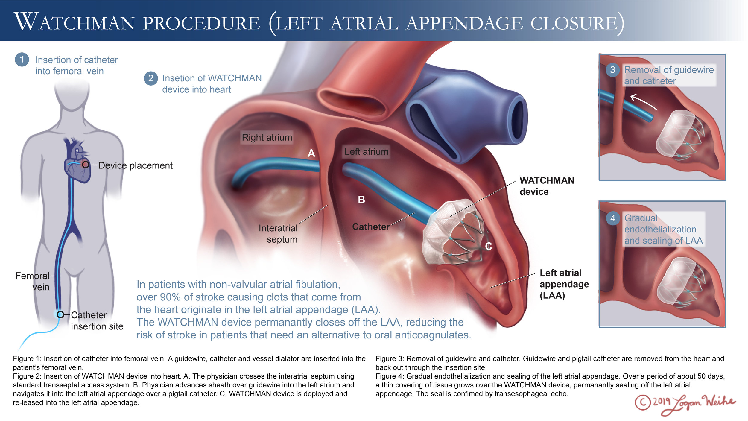 WATCHMAN Device (Left Atrial Appendage Closure)