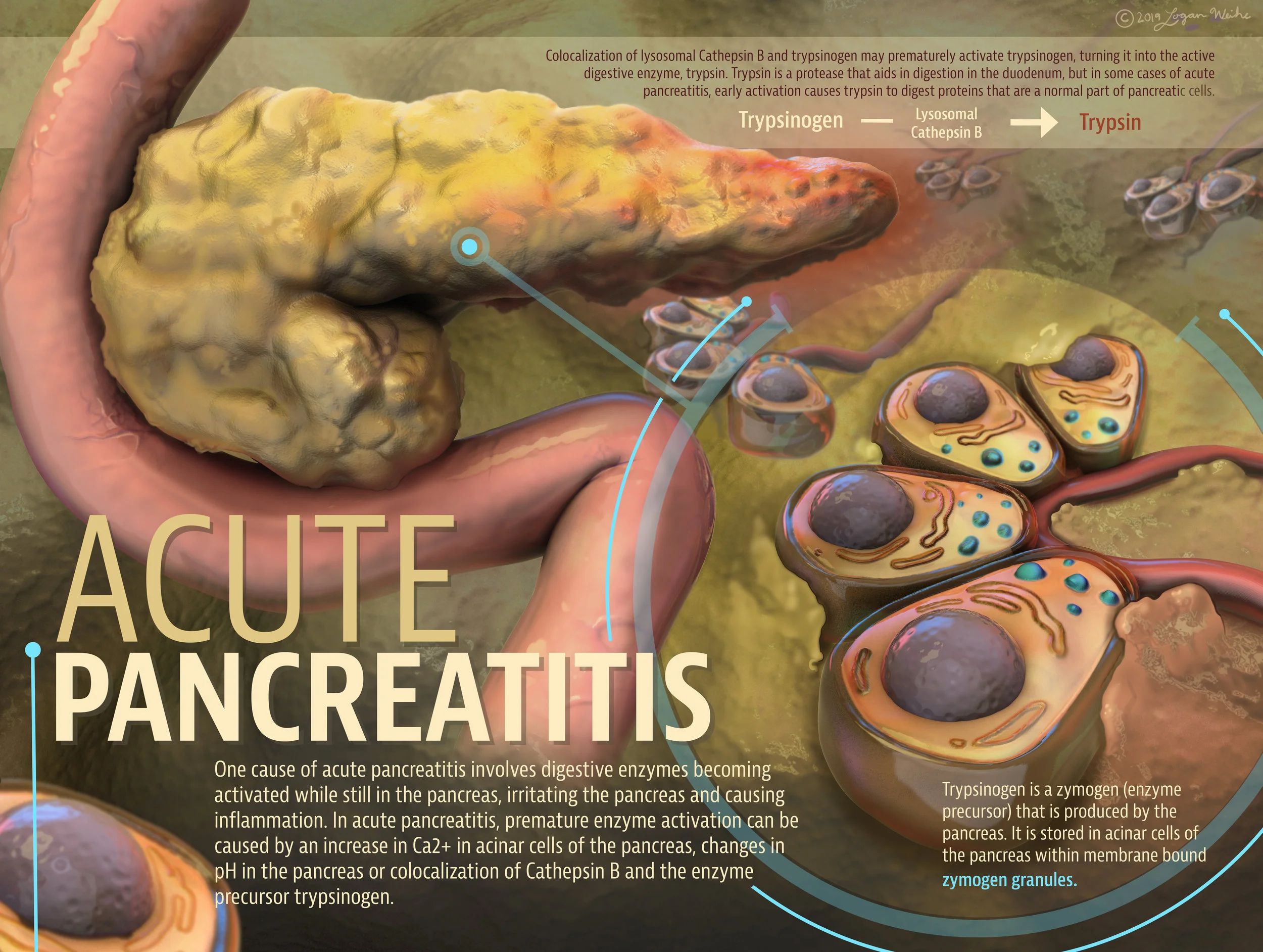 Acute Pancreatitis
