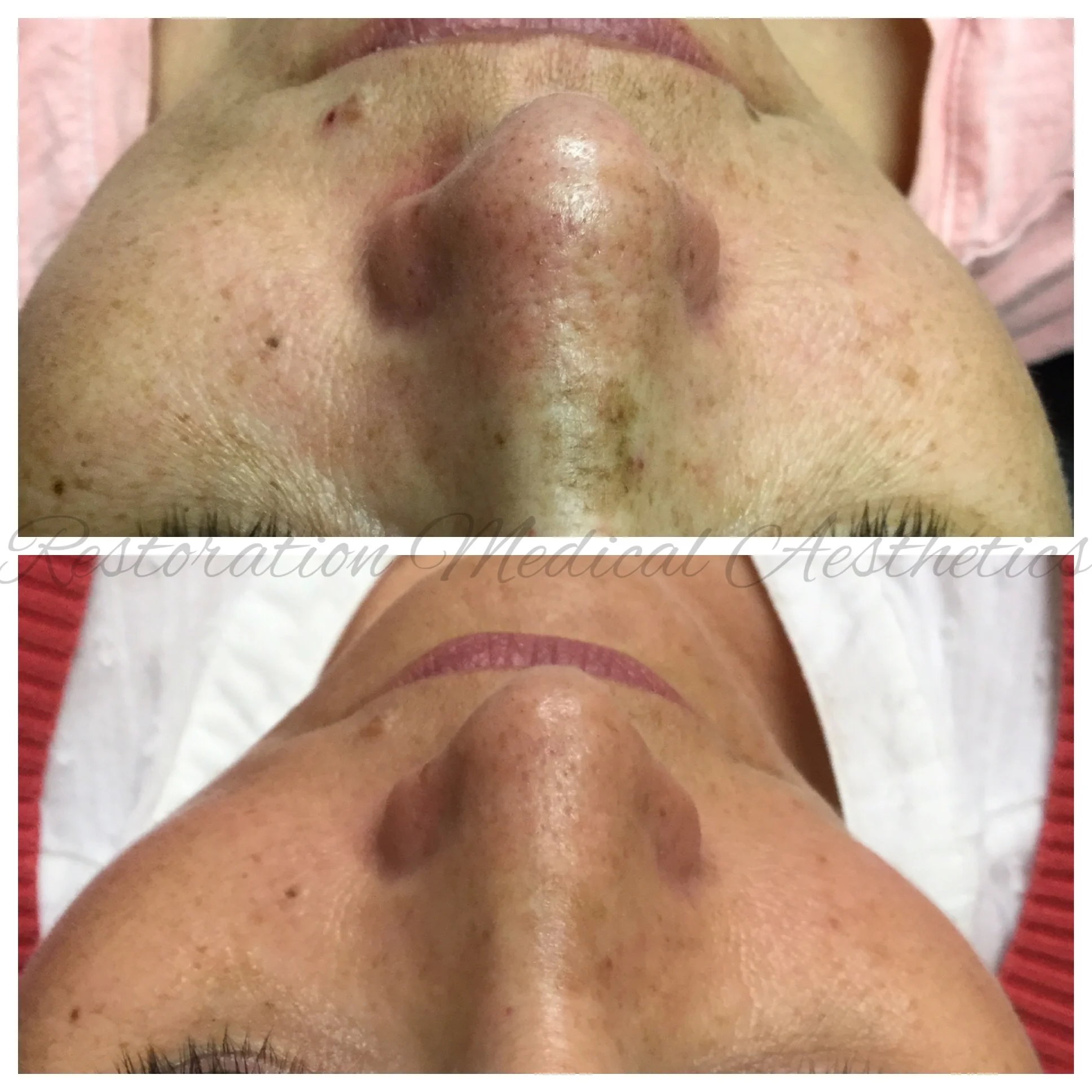 photofacial.jpg