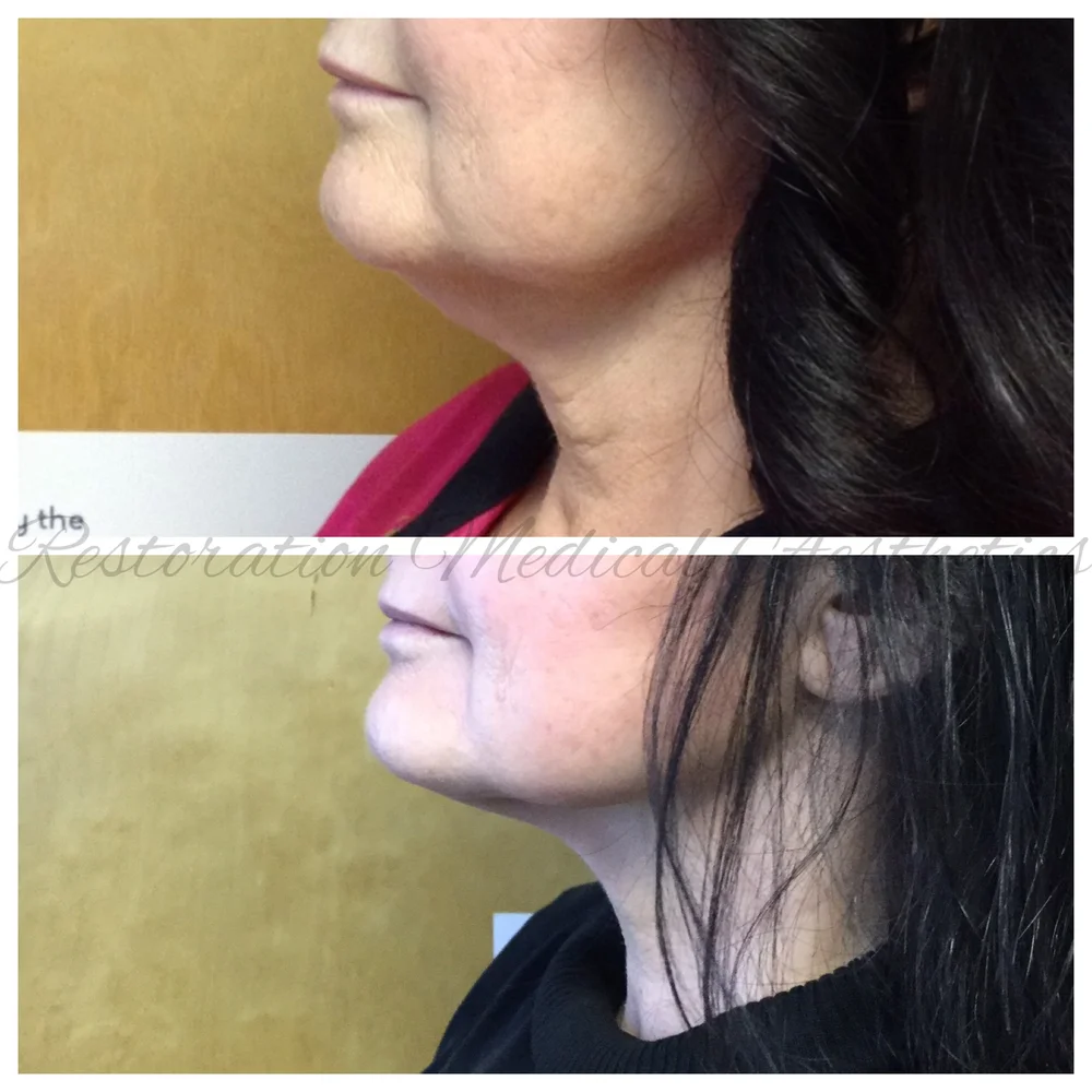 Before & Afters — Restoration Medical Aesthetics