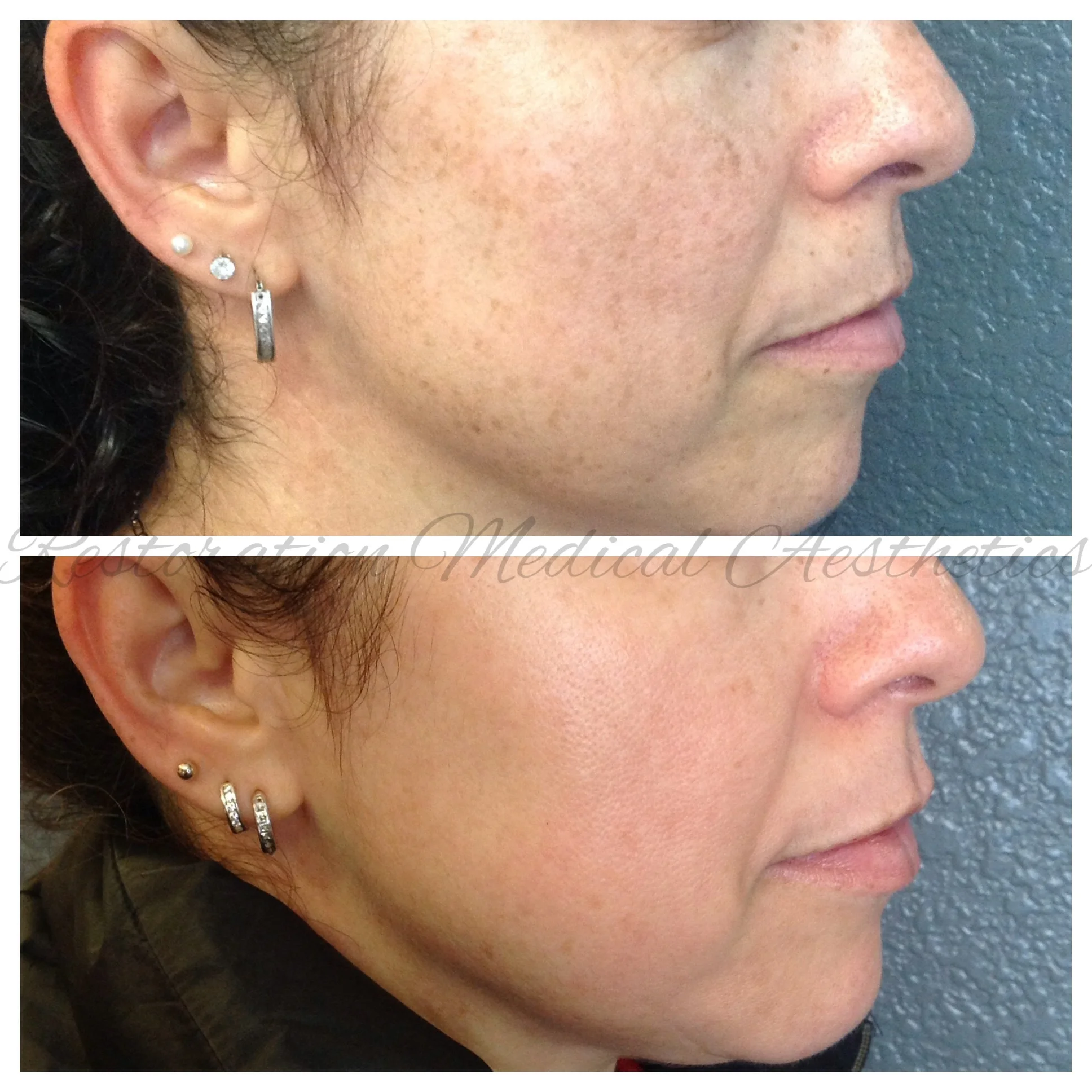 Photo Rejuvenation (Photofacial) — Restoration Medical Aesthetics