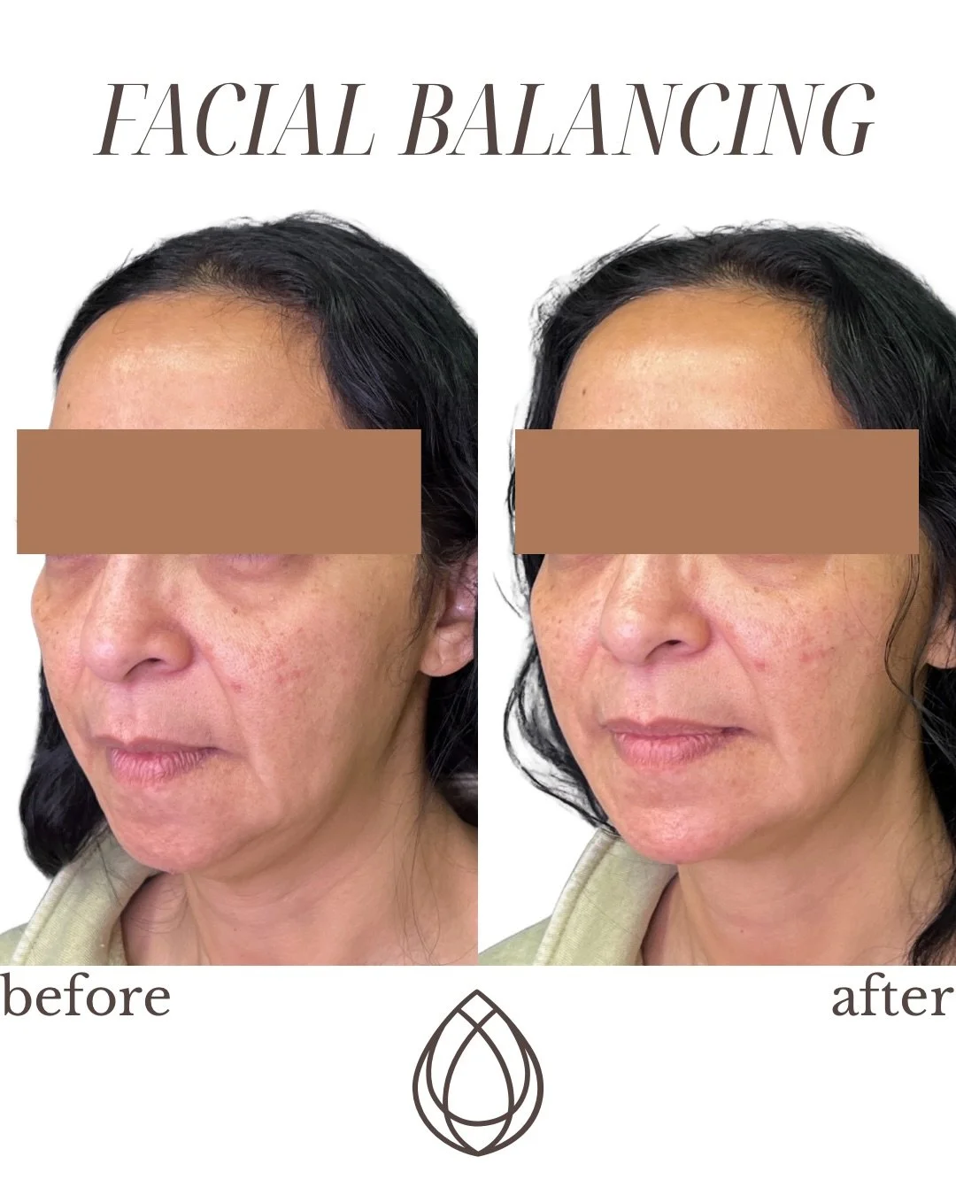 First session. Fresh results. ✨
This before &amp; after shows what facial balancing with dermal filler can do, even after just one visit. Strategic placement to enhance proportions, restore harmony, and keep everything looking natural and refreshed.
