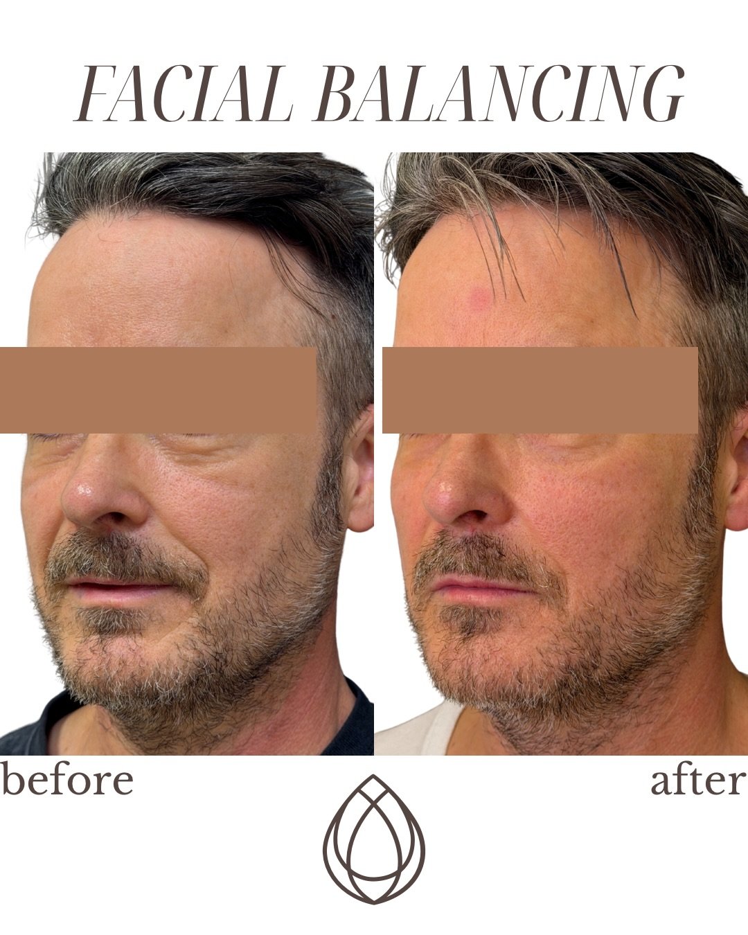 Balance changes everything ✨
This is the power of facial balancing with dermal filler. Just subtle enhancements that create harmony, structure, and a naturally refreshed look.

Customized. Strategic. Always done right.

Ready for your own glow-up? Bo