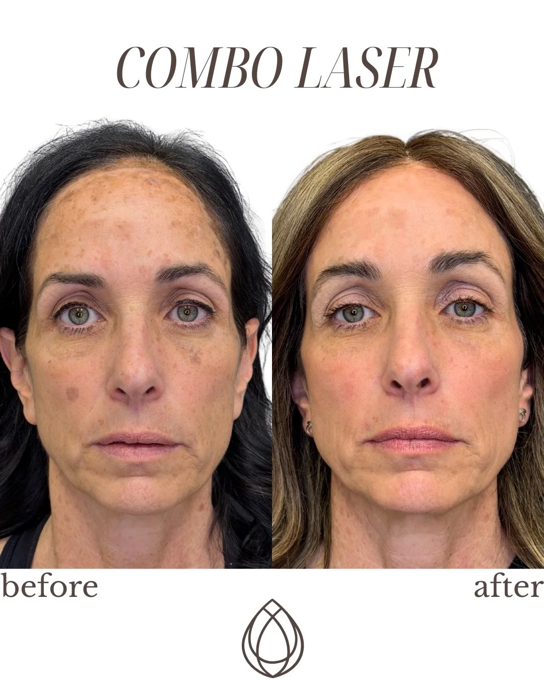 For years, pigment and uneven texture were something she struggled with.
It&rsquo;s easy for concerns like this to slowly chip away at your confidence, especially when it feels like nothing truly works.

Together, we created a plan to help her feel m