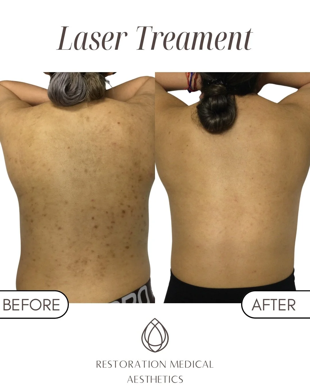 Results like this don&rsquo;t happen overnight ✨

Achieved with a series of ProFractional and Photofacial treatments to improve texture and pigmentation.

Because real results come from consistency ✨

📍 @restorationmedaesthetics 
⚡️ @pielbyjenny 

#