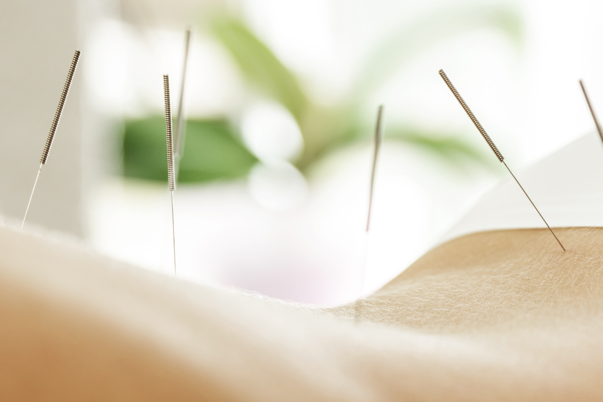 ACUPUNCTURE AND DRY NEEDLING IN WINNIPEG: TARGETED TREATMENT FOR PAIN AND MUSCLE TENSION
