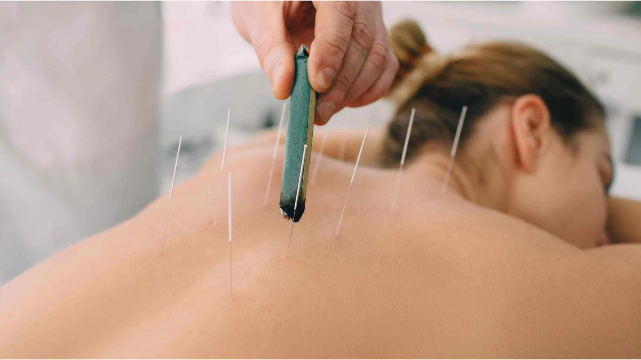 une femme recevant une session d'acupuncture